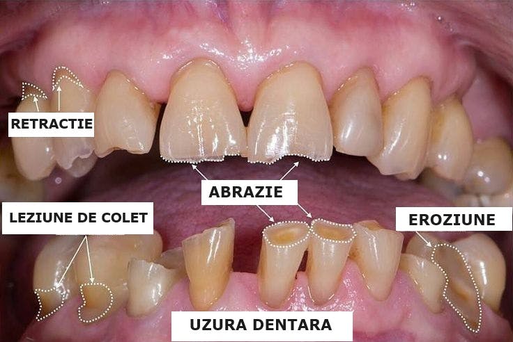 Terapia uzurii dentare 3 STEP. Tehnica adeziva în 3 pasi